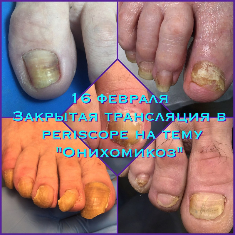 Обложка курса «Онихомикоз, 2017 (Агата Черная)»