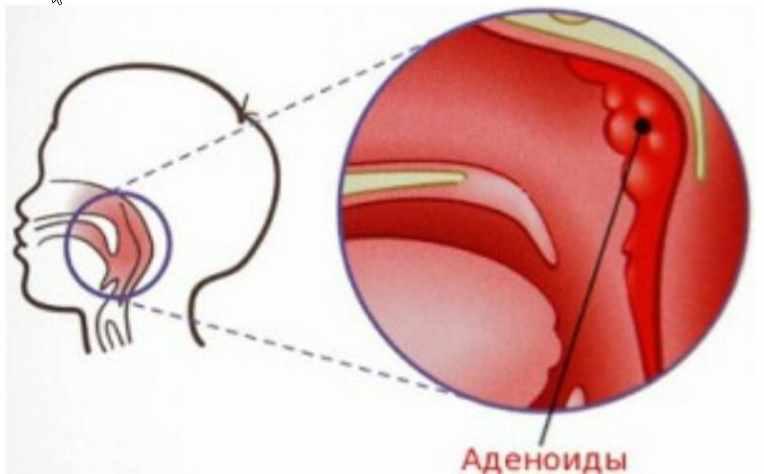 Аденоиды казнить нельзя помиловать (Елена Леднева)