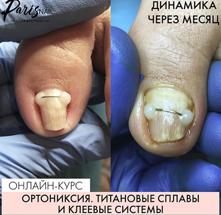 Обложка курса «[ParisNail] Ортониксия. Титановые сплавы и клеевые системы (Карина Шурыгина)»