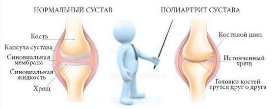 Реаматоидный полиартрит (Игорь Кауфман)