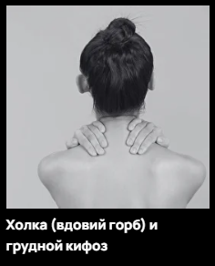 Обложка курса «Холка - вдовий горб и грудной кифоз (Александр Волоткевич)»